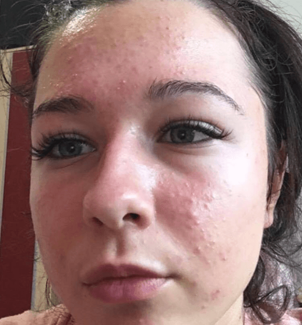 Martina — před, akné